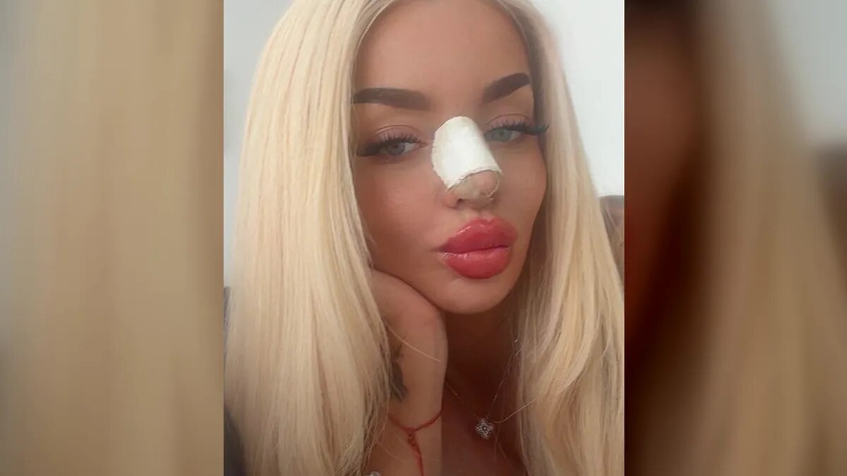 Katja Krasavice: Vierte Nasen-OP – was die Ärzte dafür aus ihrem Körper nahmen
